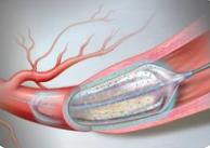 藥物球囊有望代替支架治療冠心病